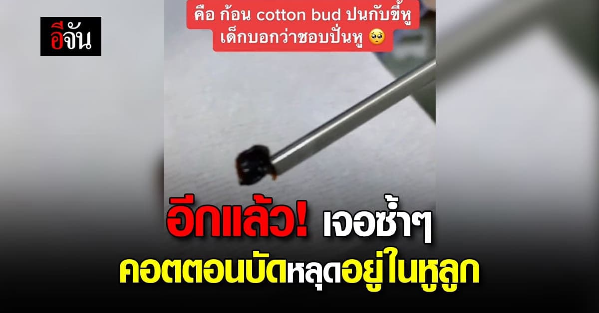 แพทย์เตือน! พ่อแม่ที่ใช้คอตตอนบัดปั่นหูให้ลูกระวังตกค้างในหู
