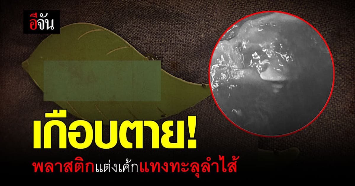 กินอะไรดูให้ดี! ชายอายุ 60 ปี ผ่าตัดด่วน เหตุเกิดจากเค้ก