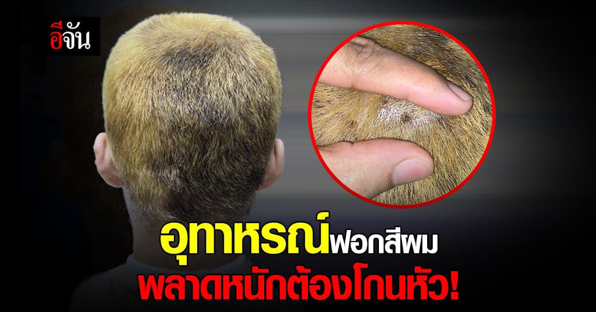 สาวสุดเซ็ง ช่างทำผมเปลี่ยนน้ำยาฟอกสี ทำหัวเป็นแผล