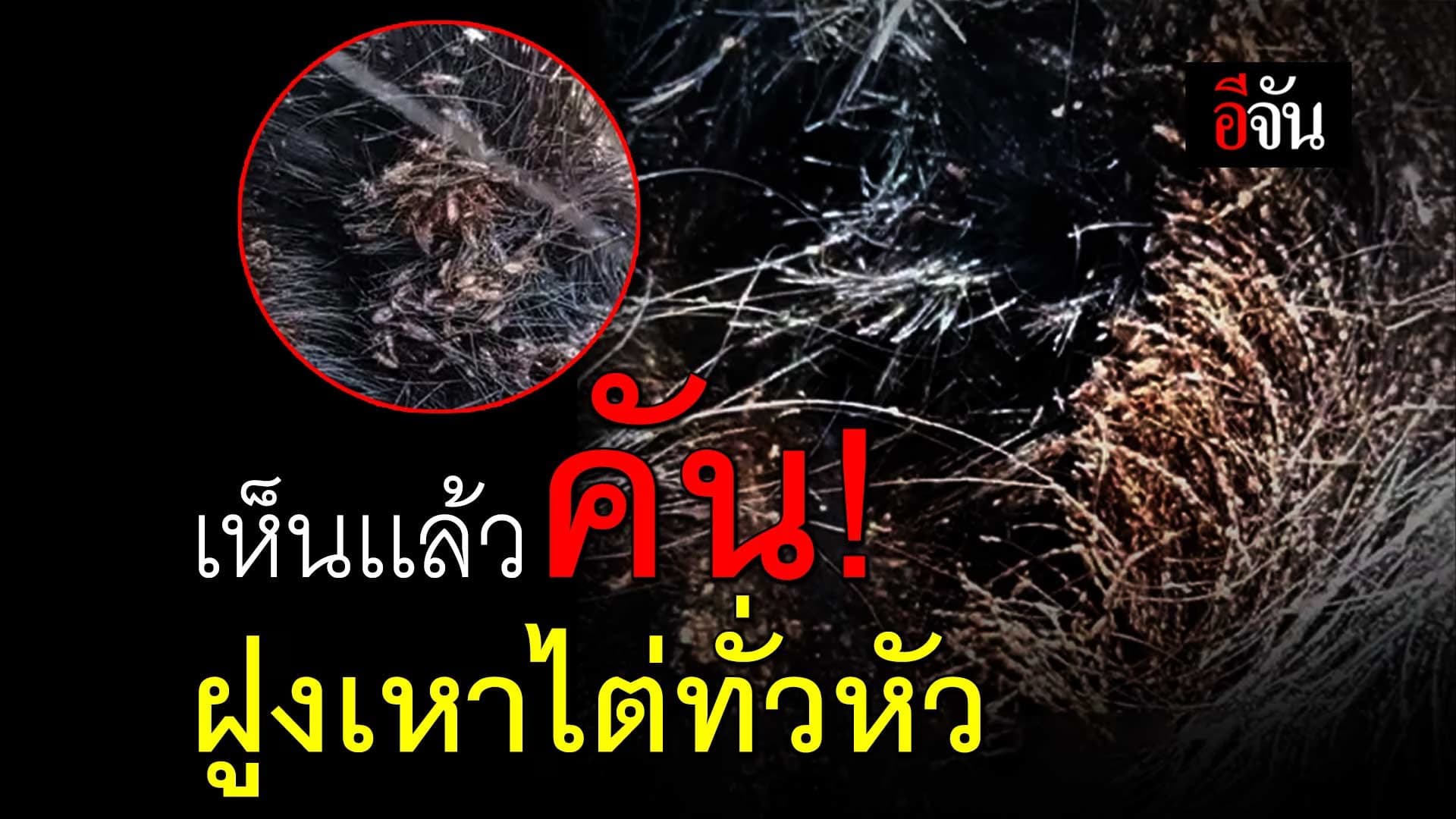 🎬 เห็นเเล้วคัน! ฝูงเหาไต่ทั่วหัว