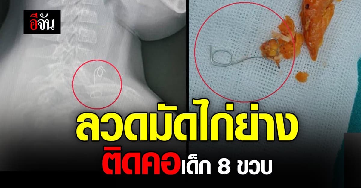 หมอเตือน เจอเด็กลวดติดคอ หลังกินไก่ย่างมีลวดปลายไม้