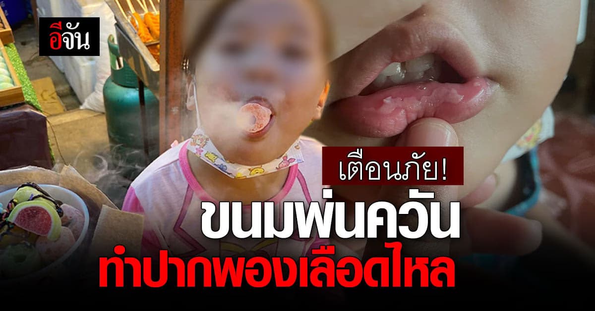 แม่เล่าอุทาหรณ์ ขนมไนโตรเจนเหลว ไม่รอระเหย ทำลูกปากพอง