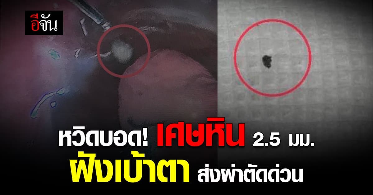 หวิดบอด ใช้เครื่องตัดหญ้าไม่ป้องกัน หินทะลุฝังเบ้าตา กระจกตาฉีกขาด