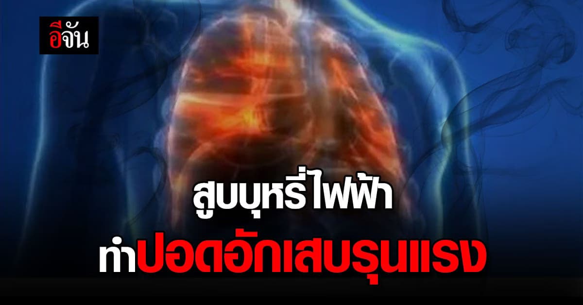 “โรคอิวารี่” ปอดอักเสบรุนแรง จากสูบบุหรี่ไฟฟ้า