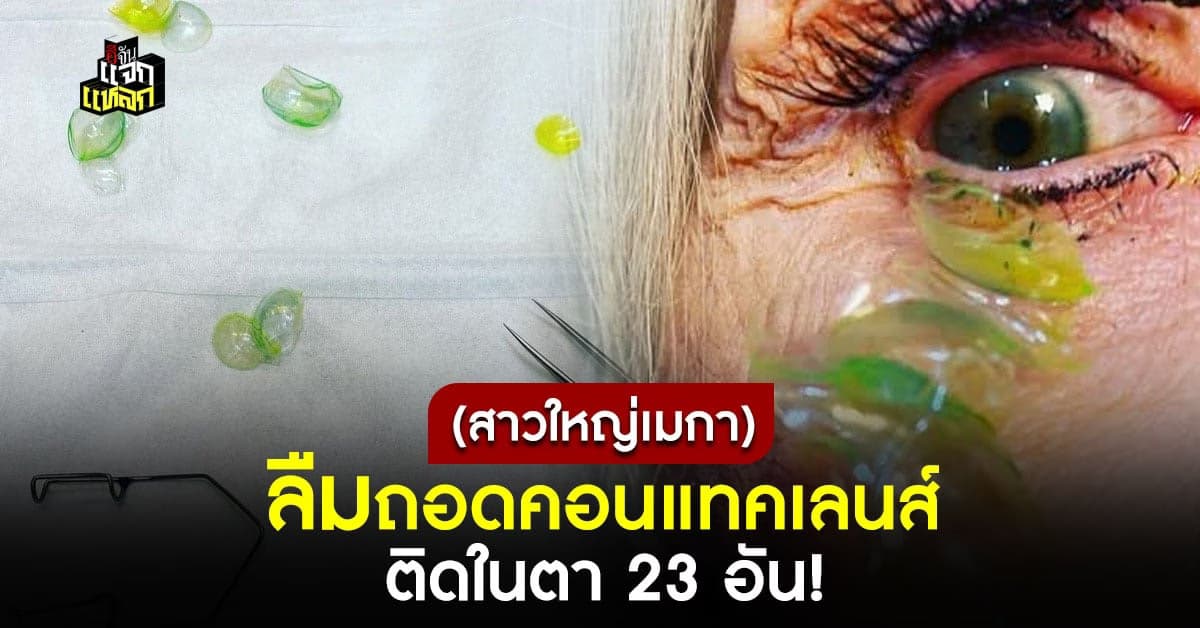 ขนลุก สาวใหญ่อเมริกา ลืมถอดคอนแทคเลนส์ ติดกัน 23 อัน