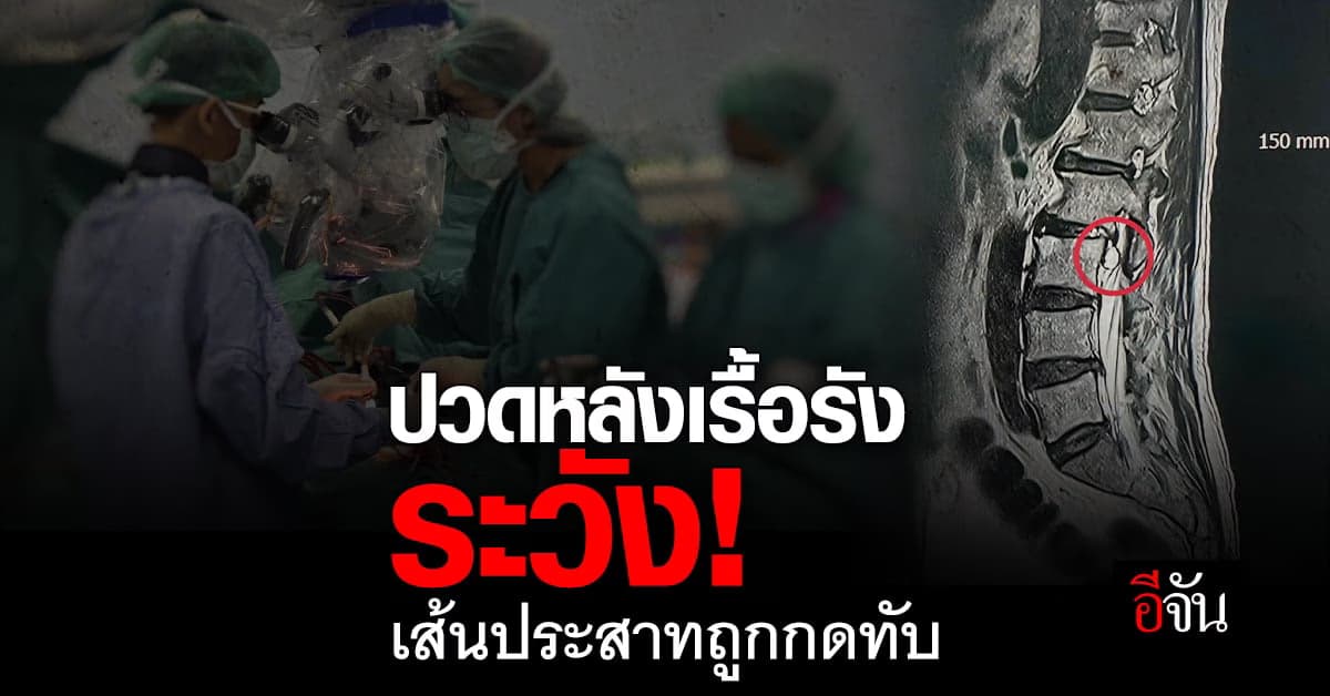 หนุ่มใหญ่ปวดหลัง ปวดสะโพก อาการเรื้อรัง กินยาไม่หายสุดท้ายต้องผ่าตัด