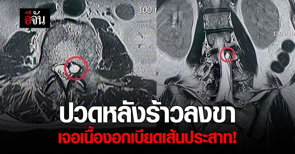 ปวดหลัง ปวดสะโพก ร้าวลงขา อย่าละเลย รีบปรึกษาหมอ!