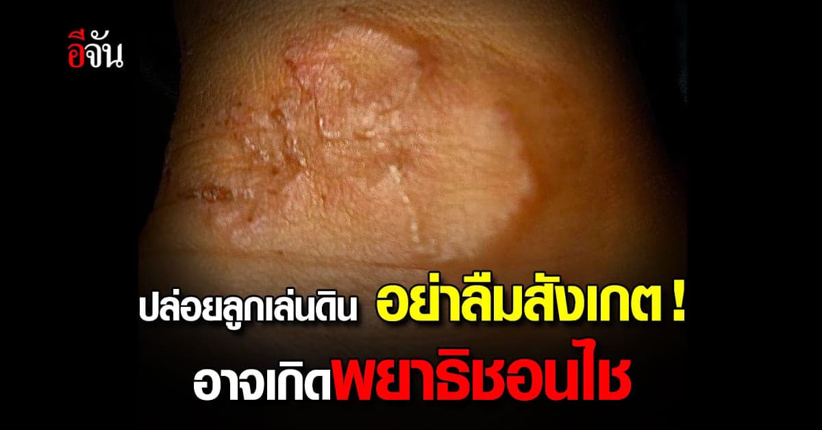 เตือนภัยสำหรับพ่อแม่ๆ อย่าลืมสังเกตลูกหลังปล่อยให้เล่นดิน