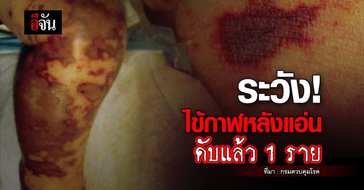 ระวัง โรคไข้กาฬหลังแอ่น ขณะนี้ผู้เสียชีวิตแล้ว 1 ราย ที่จังหวัดกระบี่
