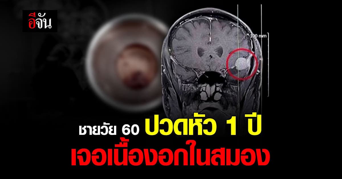 ชายวัย 60 ปวดหัวนาน 1 ปี ตรวจเจอ เนื้องอกในสมอง