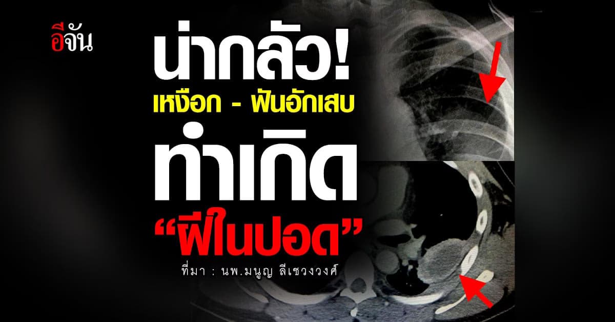 หมอมนูญ เผย เหงือกฟันอักเสบ! ทำเกิดฝีในปอด