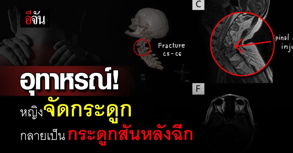 อุทาหรณ์ หญิงวัย 48 ปี จัดกระดูก กลายเป็น กระดูกสันหลังฉีก