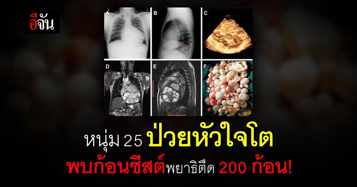 ซีสต์ 200 ก้อน จากพยาธิตืด ทำป่วย โรคหัวใจโต!