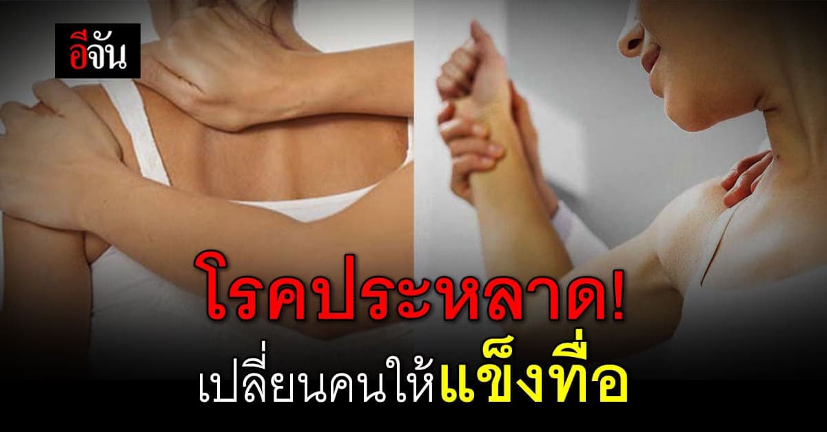 โรคคนแข็ง โรคประหลาดรู้ไว้ไม่เสี่ยงโอกาสเป็น 1 ในล้าน