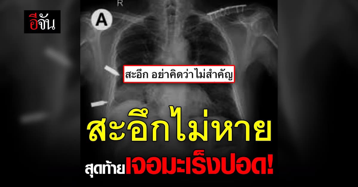 สะอึกไม่หาย อย่าคิดว่าไม่เป็นไร อาจเสี่ยงมะเร็งปอด