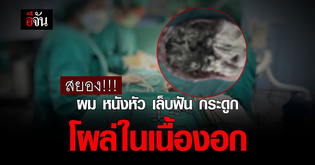 เคสสยอง ผู้ป่วยหญิง ผ่าเนื้องอก เจอ ผม ฟัน เล็บ ในเนื้องอก