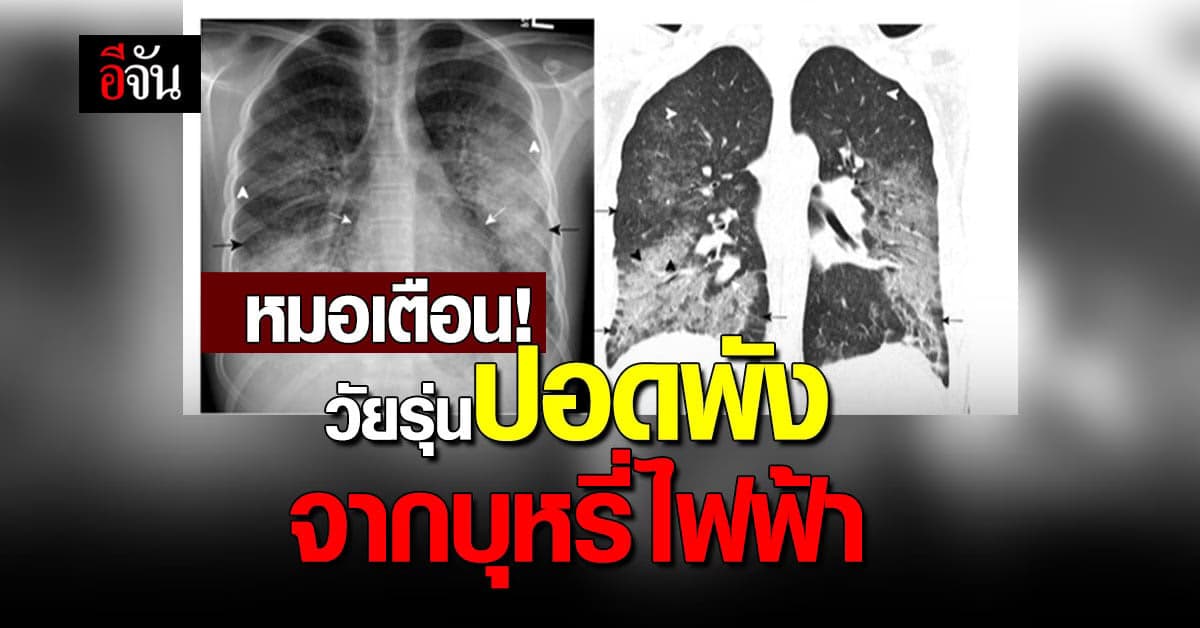 หมอเตือน วัยรุ่นอายุ 10 กว่าปี ปอดอักเสบเพราะบุหรี่ไฟฟ้า