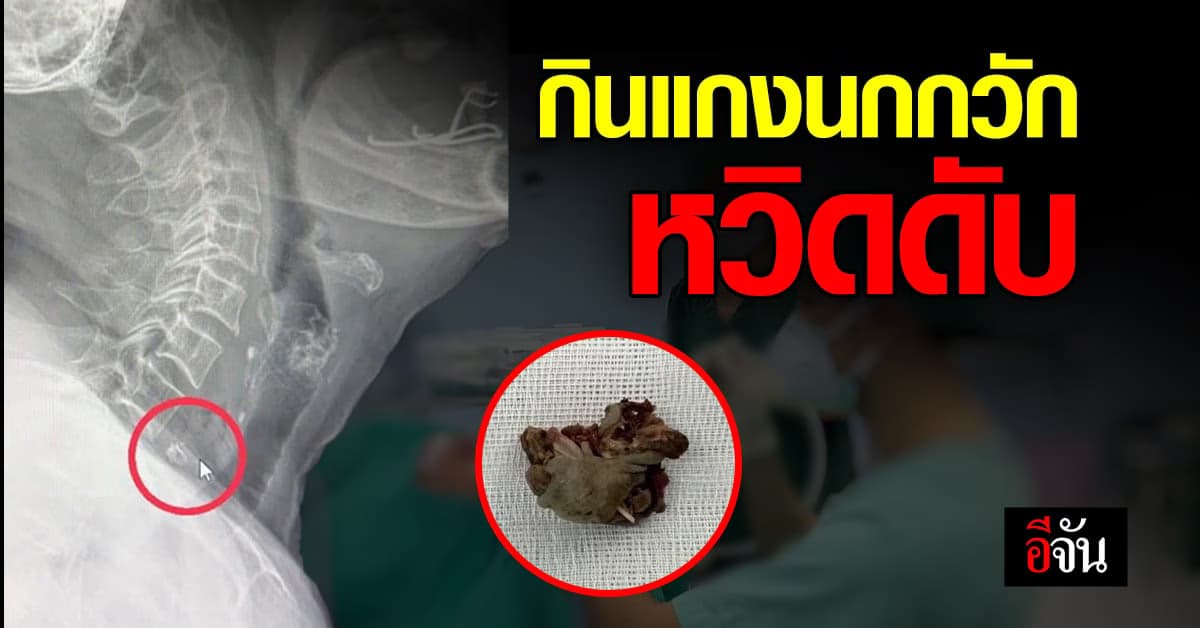หวิดดับ กินแกงนกสับ ติดคอ หายใจติดขัด ต้องผ่าตัดฉุกเฉิน