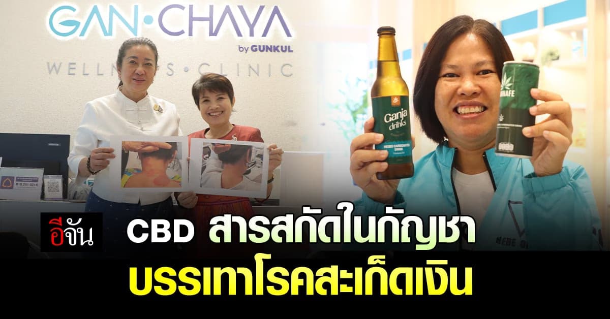 CBD สารสกัดในกัญชา ใช้บรรเทาโรค สะเก็ดเงิน