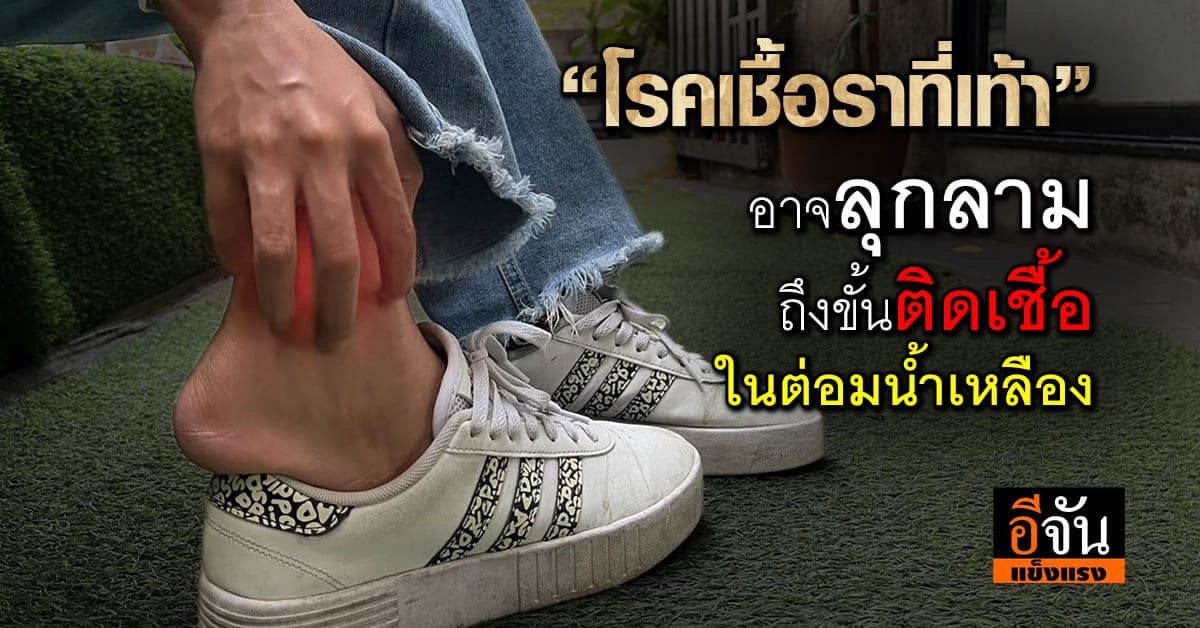 “โรคเชื้อราที่เท้า” ไม่รักษาเสี่ยงลุกลามจนติดเชื้อในต่อมน้ำเหลือง