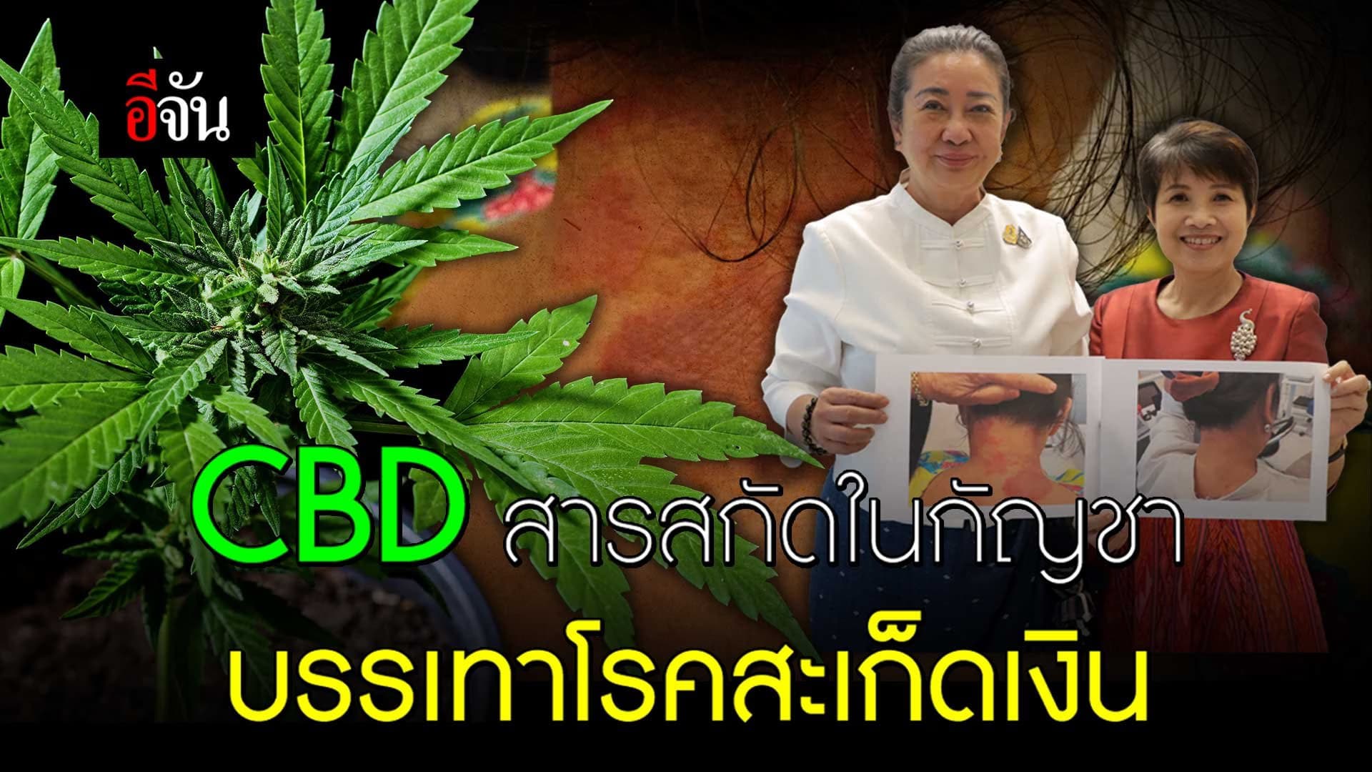 🎬 CBD สารสกัดในกัญชา บรรเทาโรคสะเก็ดเงิน