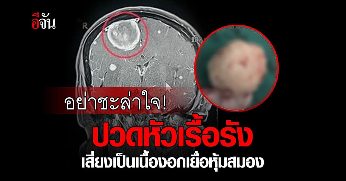 หมอเตือน! ปวดหัวบ่อยต้องระวัง เสี่ยงเป็นโรคเนื้องอกเยื่อหุ้มสมอง