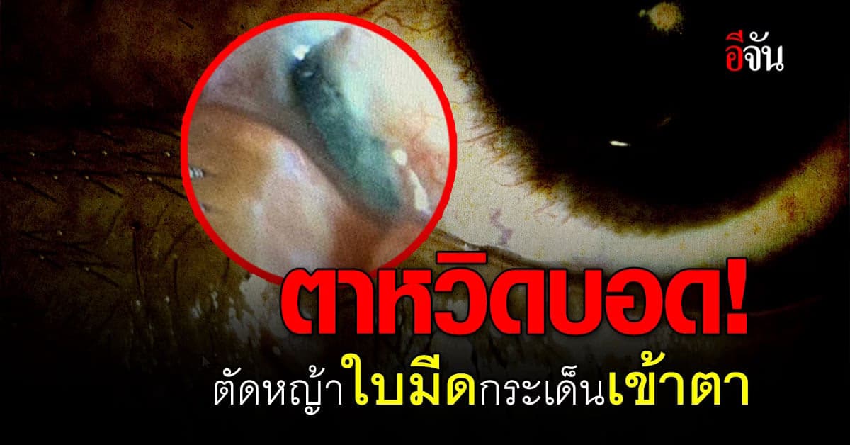 หมอเตือน! ตัดหญ้า ควรใส่อุปกรณ์ป้องกันใบมีดตัดหญ้ากระเด็นปาดตา