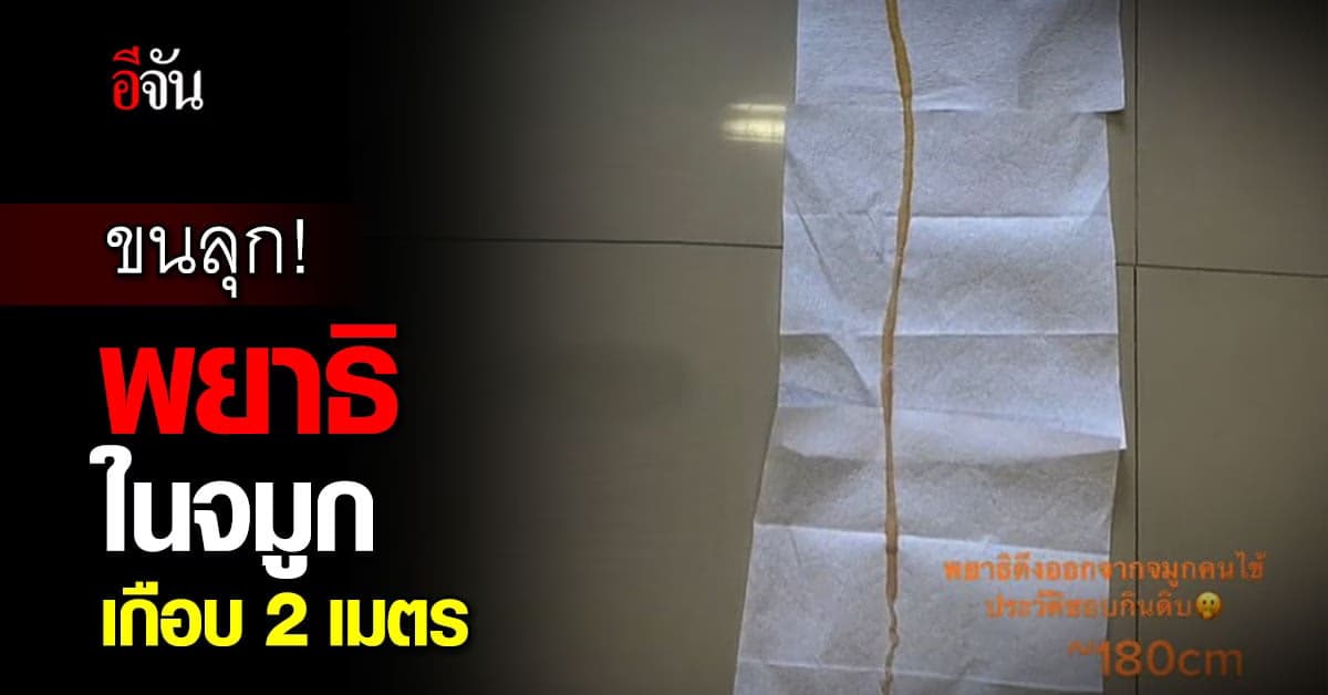 สุดสยอง! พยาธิในจมูกคนไข้ ยาวเกือบ 2 เมตร