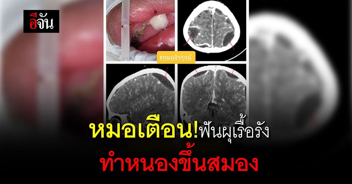 อันตราย! หมอเตือนฟันผุต้องระวัง เพราะทำหนองขึ้นสมองได้