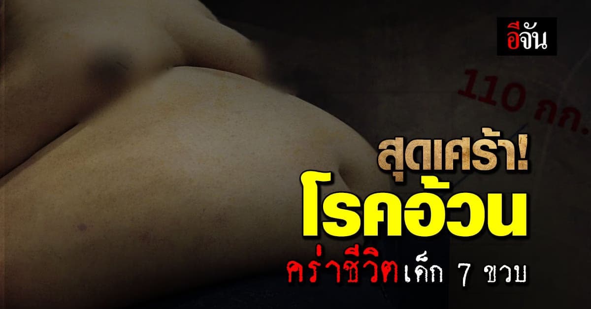 หมอ ยกเคสเด็ก 7 ขวบดับ เพราะภาวะอ้วนรุนแรง เตือน ผปค.ดูแลเรื่องอาหาร