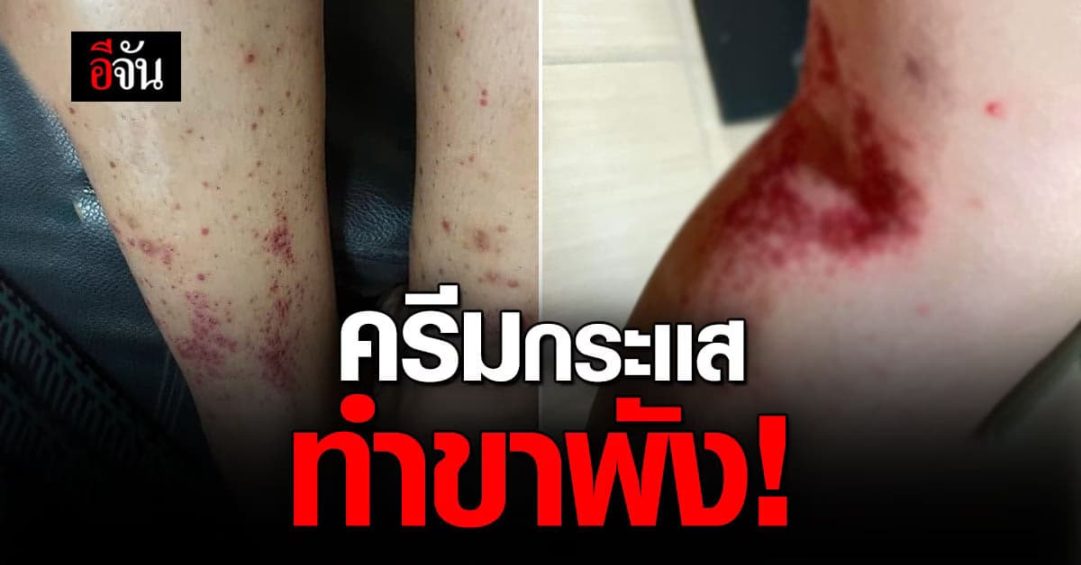 หมอแล็บแพนด้า โพสต์เตือน ครีมกระเเส ควรทดสอบก่อนใช้