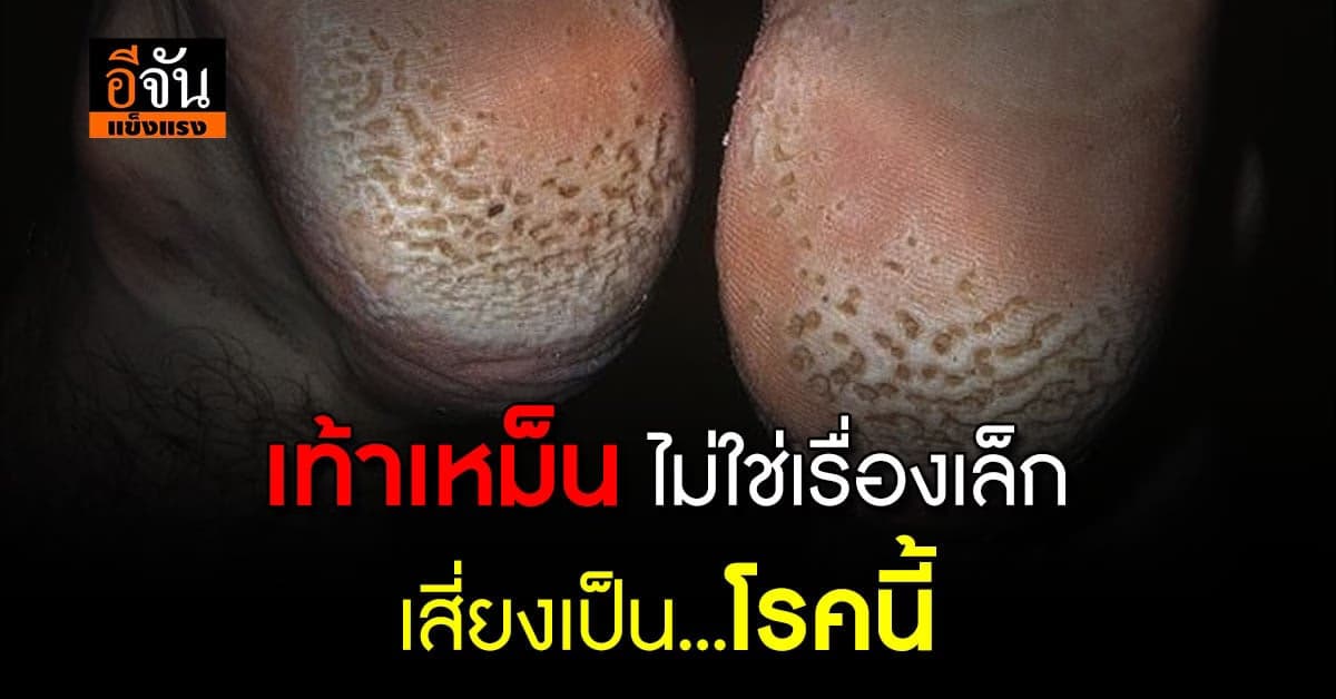 โรคเท้าเป็นรู! ไม่คัน ไม่เจ็บ แต่เหม๊นเหม็น