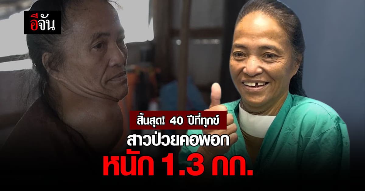 รอยยิ้มที่กลับมา! เรื่องราวหญิงทรมานกว่า 40 ปี ที่เป็นโรคต่อมไทรอยด์