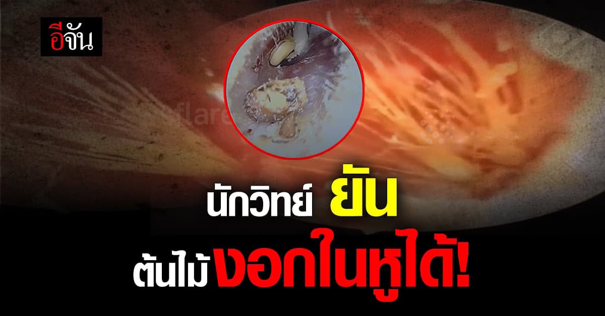 อึ้ง! นักวิทย์ ยืนยัน ต้นไม้งอกในหูเกิดขึ้นได้จริง