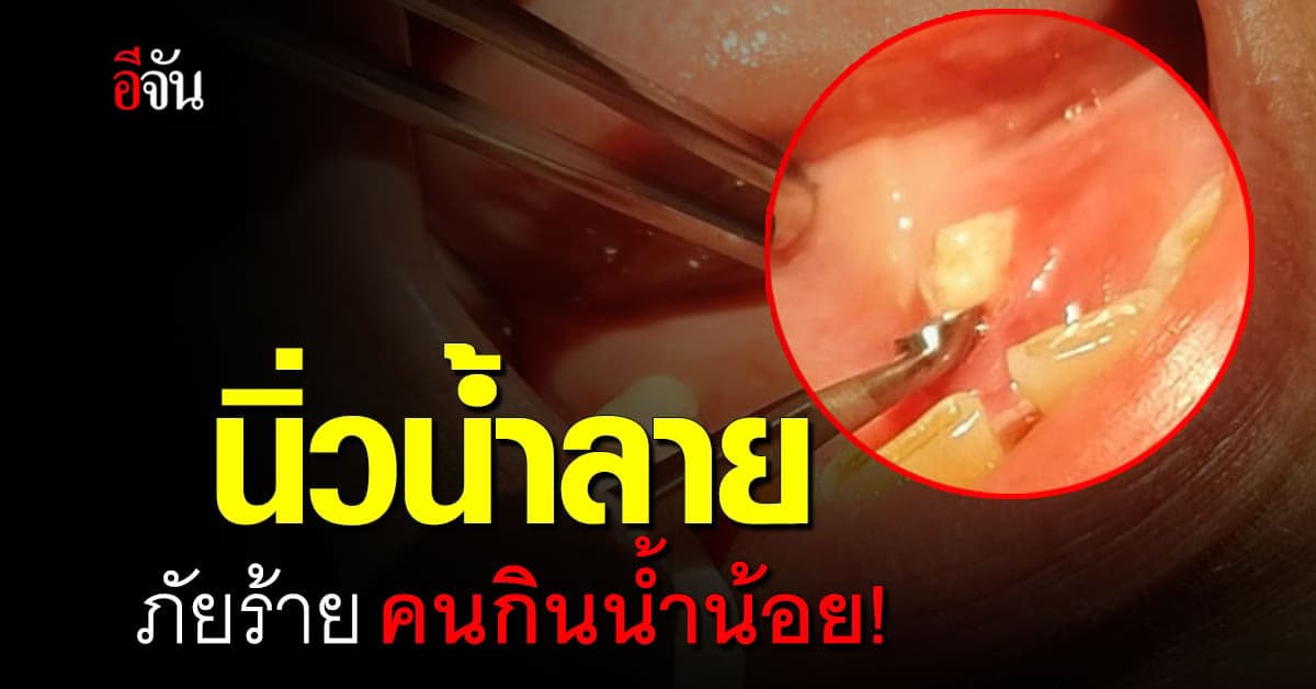 กินน้ำน้อย เสี่ยงเป็น นิ่วน้ำลาย