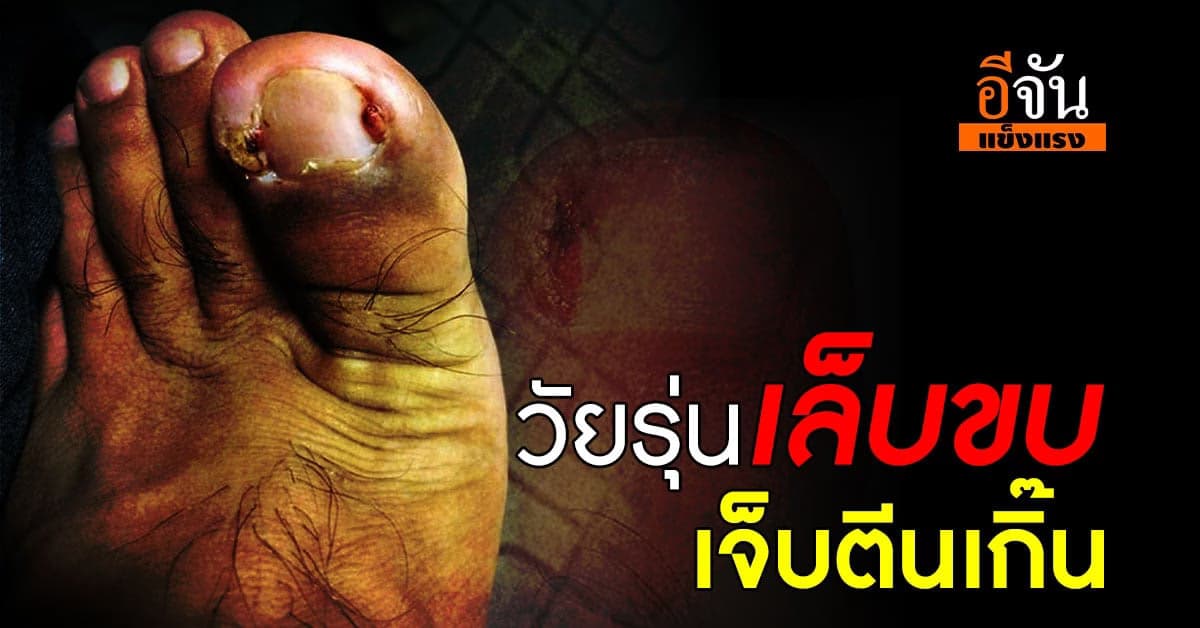 เล็บขบ! ทำเจ็บนิ้วตีนเกินทน