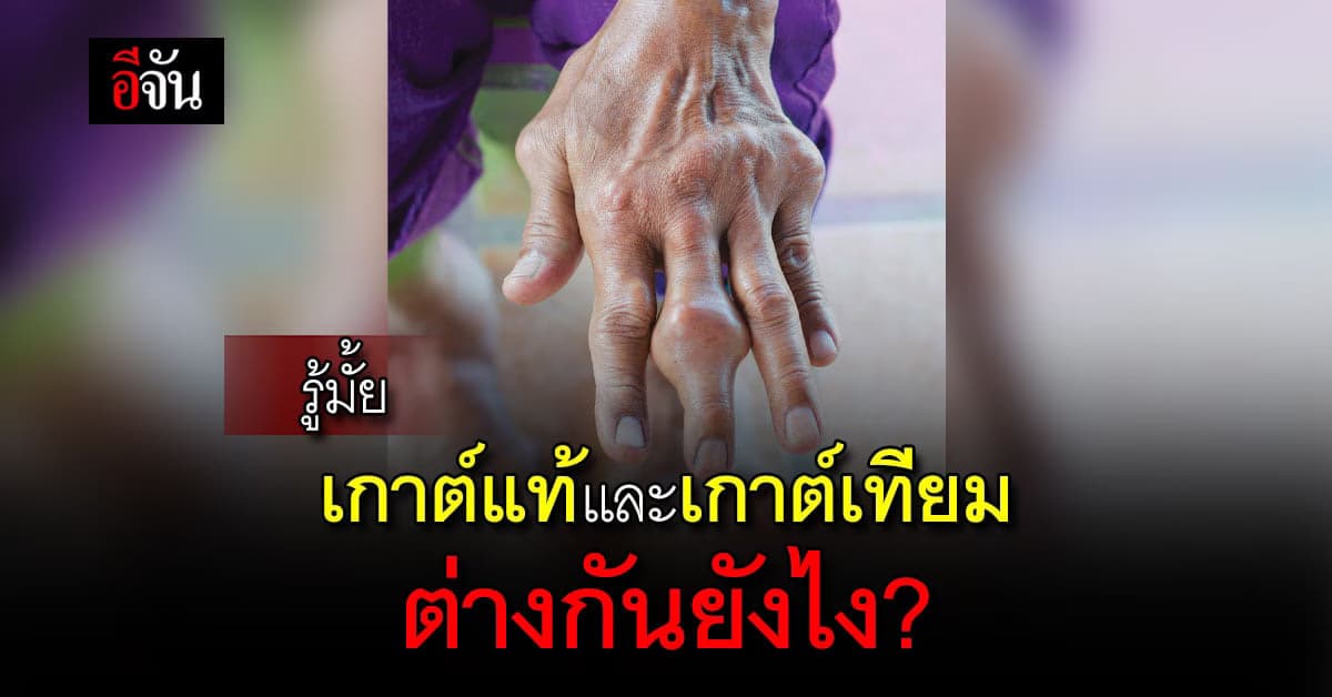 มาดูกัน! เกาต์แท้และเกาต์เทียม ต่างกันอย่างไร