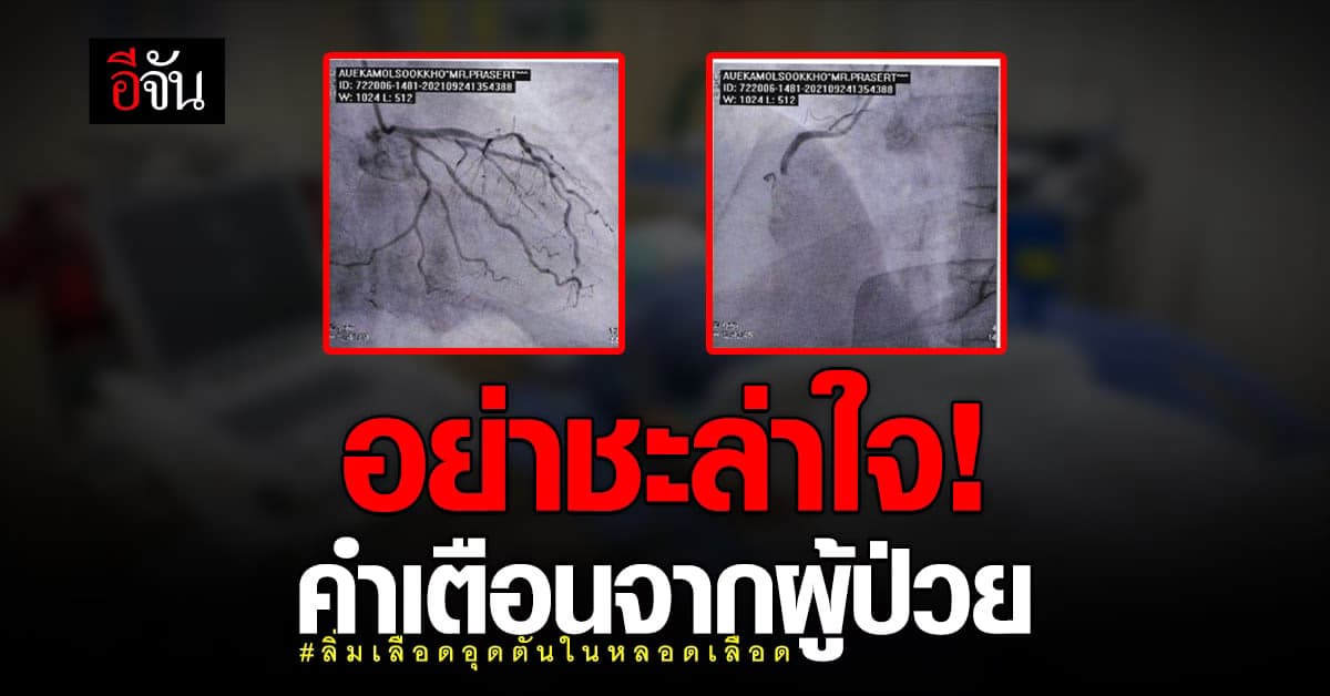 อย่าชะล่าใจ! คำเตือนจากผู้ป่วยลิ่มเลือดอุดตันในหลอดเลือด