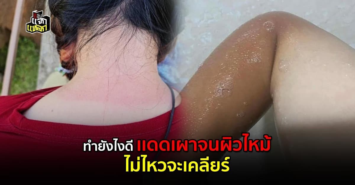 ทำไงดี ทากันเเดดเเล้วเอาไม่อยู่ ปรับการกินช่วยได้นะ