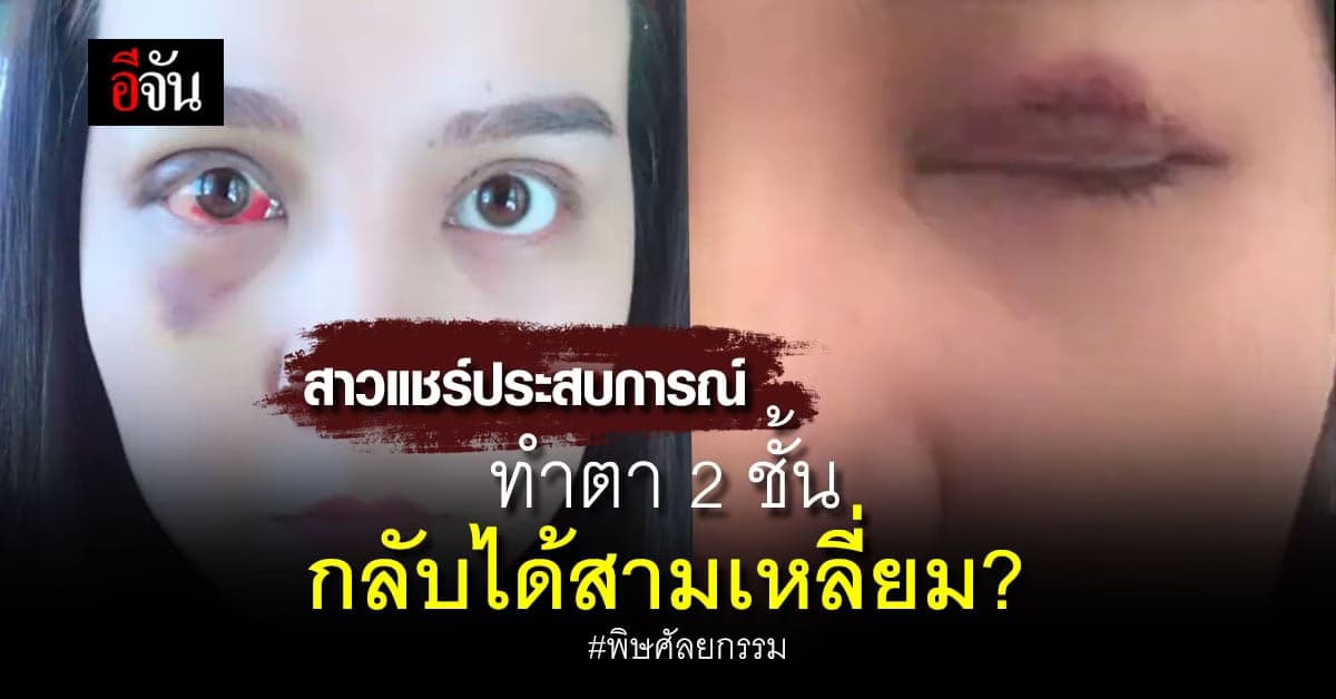 สาวแชร์ประสบการณ์ ศัลยกรรมดวงตา 2 ชั้น ได้สามเหลี่ยม