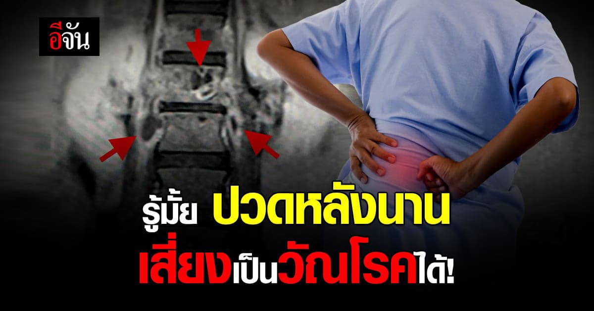 หมอมนูญ ยกเคสเตือน วัณโรคกระดูกสันหลัง ปล่อยไว้เสี่ยงพิการได้!