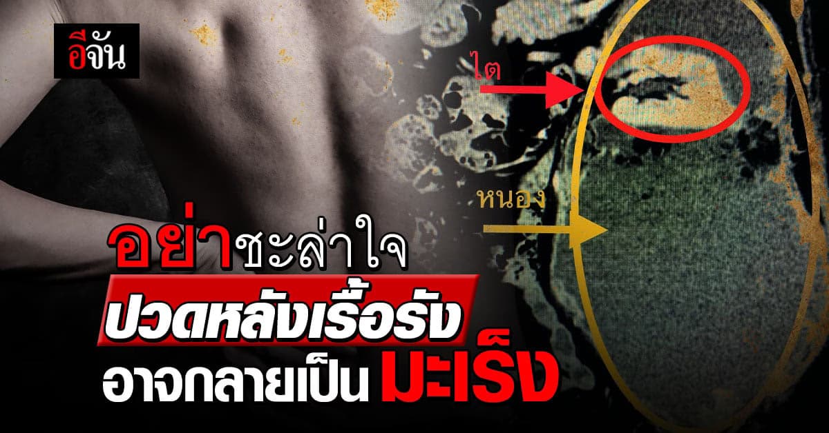 อันตรายกว่าที่คิด ปวดหลังเรื้อรัง อาจเป็นอาการของมะเร็ง
