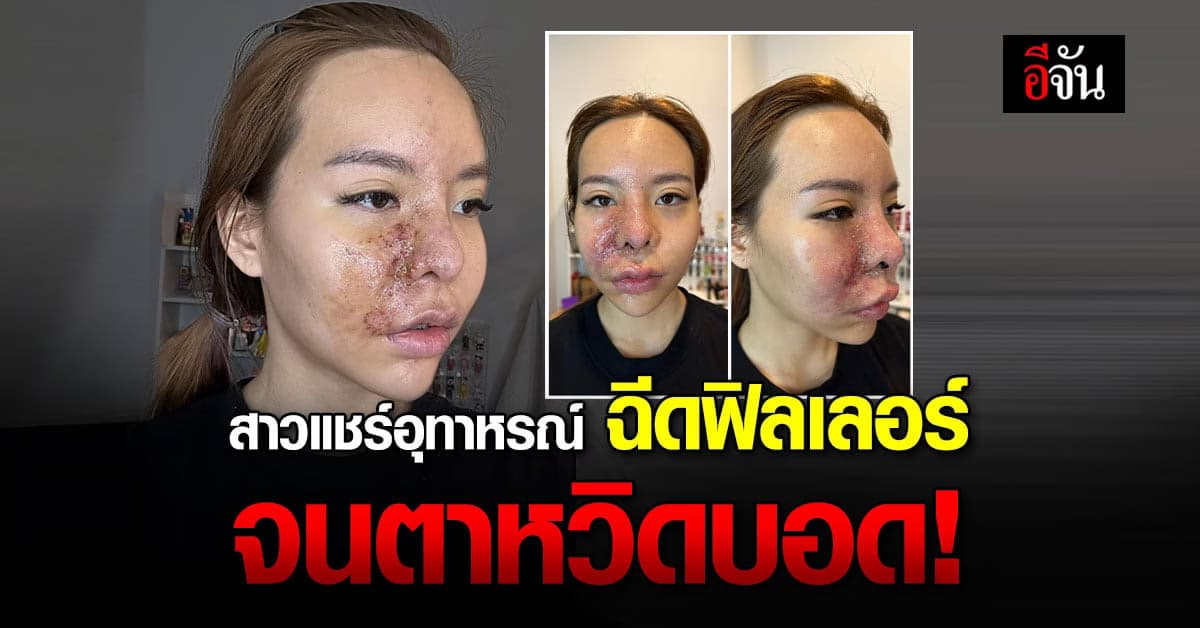 สาวเตือนเป็นอุทาหรณ์! ฉีดฟิลเลอร์กับหมอเถื่อน จนตาหวิดบอด