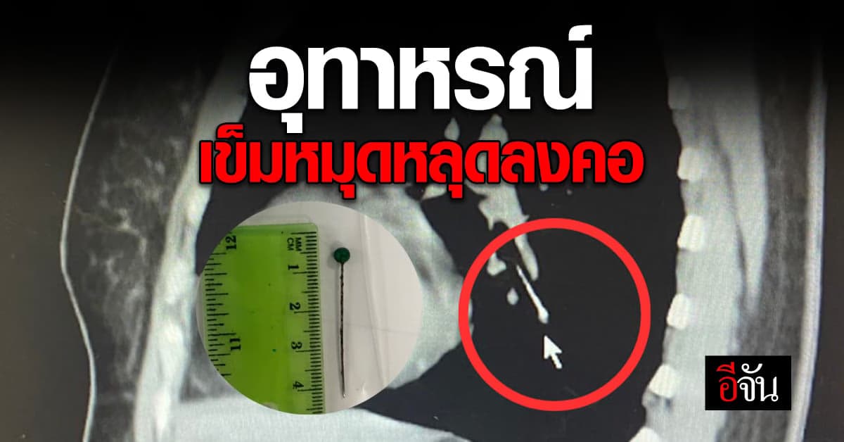 อุทาหรณ์ หญิงคาบเข็มหมุดไว้ที่ปาก ก่อนสำลักหลุดลงคอ