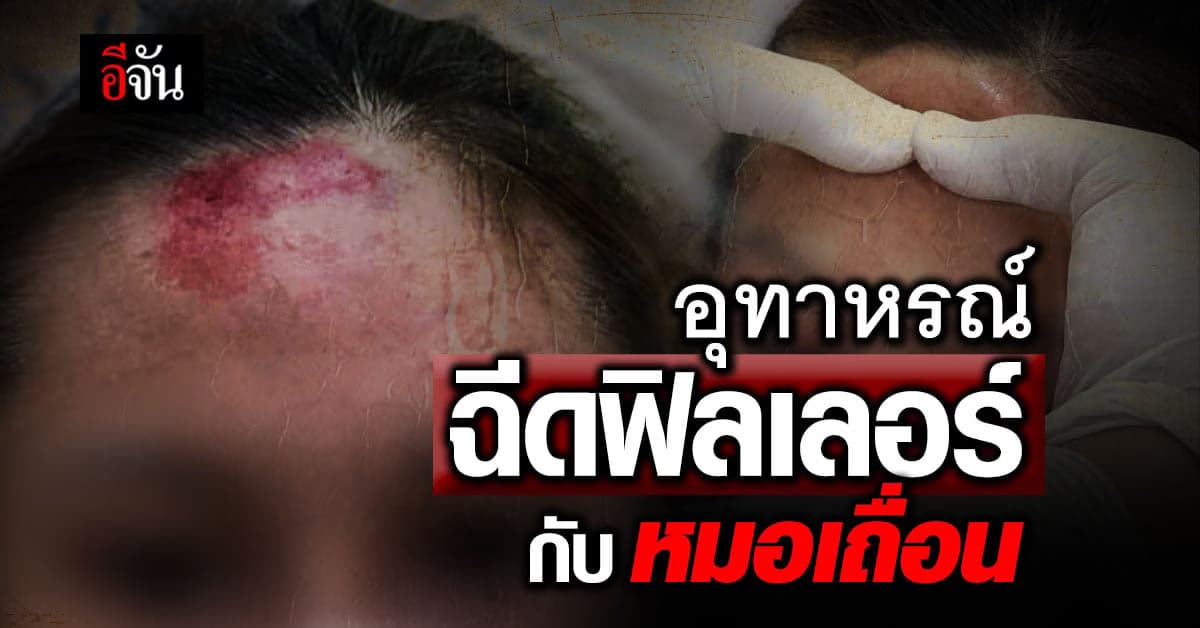 หมอเล่า อุทาหรณ์ สาวฉีดฟิลเลอร์กับหมอเถื่อน หน้าผากบวมเป็นก้อน