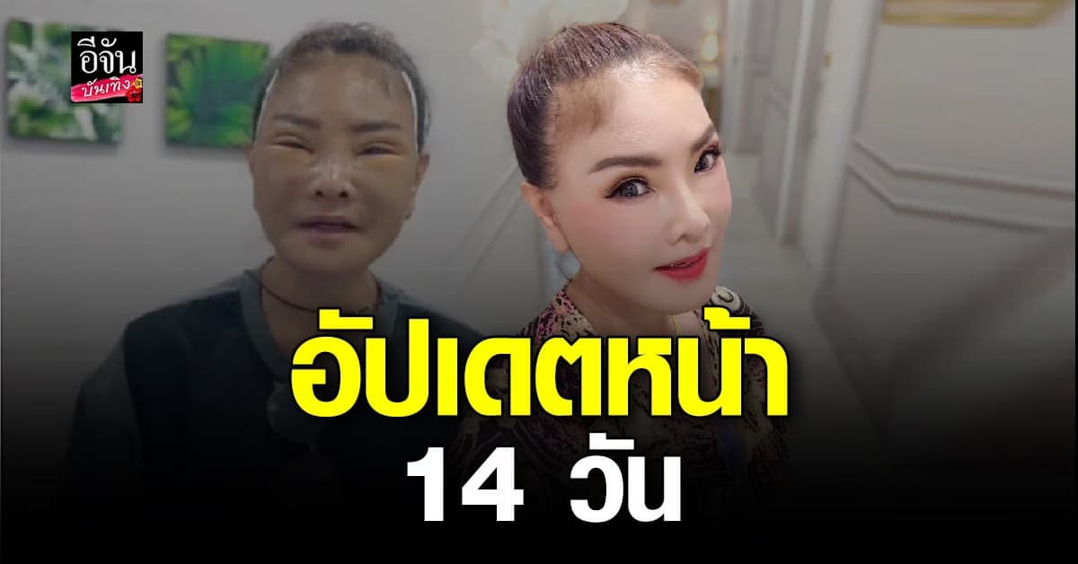 ดาว มยุรี หลังดึงหน้า 14 วัน สวยขึ้นจนหลายคนตะลึง