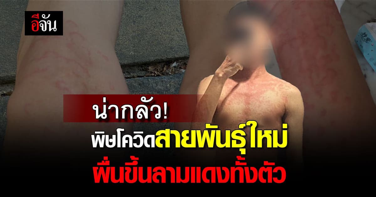 หนุ่มแชร์ประสบการณ์ ติดโควิดสายพันธุ์ใหม่ ผื่นขึ้นลามแดงทั้งตัว