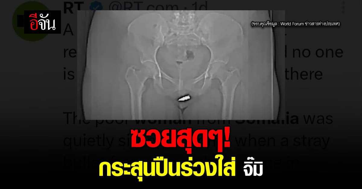 ซวย แบบแปลกๆ สาวโซมาเลีย ถูก กระสุน ตกใส่ ค้างอยู่ในคลิตอริส