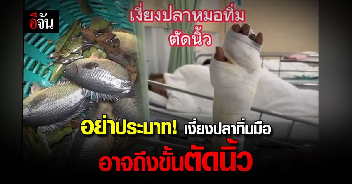 หมอศัลยกรรม เตือน เงี่ยงปลาทิ่มมือ อย่าชะล่าใจ อาจถึงขั้น ตัดนิ้ว