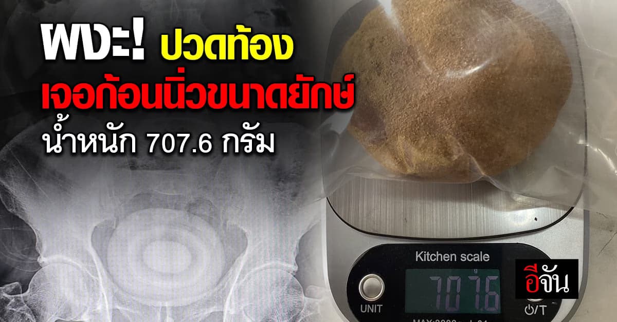 ผงะ! ปวดท้อง เจอก้อนนิ่วขนาดยักษ์ 700 กรัม